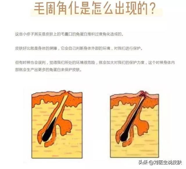 鸡皮皮肤怎么回事啊