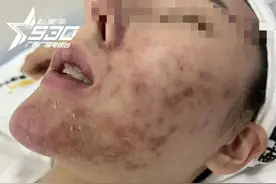 南宁00后女生“祛痘”不成反“烂脸”！美容院：是她中途放弃治疗图片