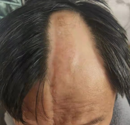 额头上鸡皮肤图片大全