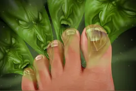 “脚气”真菌怎么治才能根除？教你3个实用方法，根治脚气不复发图片