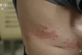 小时候得过水痘的人易患带状疱疹，疼痛等级达10级超过分娩痛图片