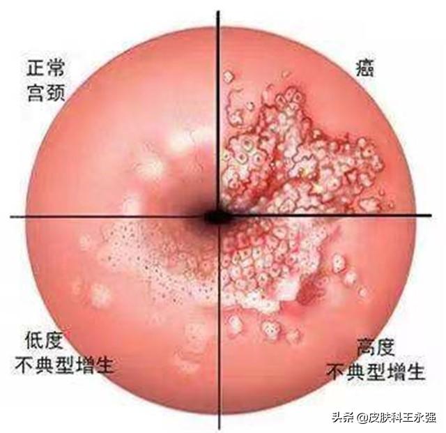 宫颈癌非角化性