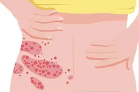 疼起来要人命的带状疱疹究竟是什么？怎么防治才好？一文为你讲清图片