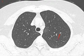 6mm磨玻璃结节万分纠结不知道如何是好？细致诊断一锤定音图片