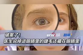 破案了！医生说掉进眼睛里的睫毛还藏在眼睛里图片