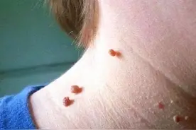 脖子和腋下的“小肉粒”是什么？能用手直接揪掉吗？别再忽视了图片