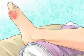 怎么自查是不是痛风？看这些小症状图片