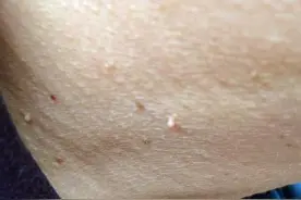 摸摸你的脖子和腋下，是不是长了“小肉粒”？直接揪掉可以吗？图片