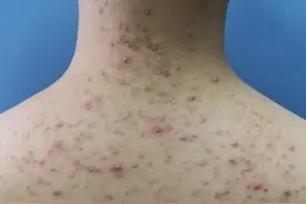 去痘坑最快的方法有哪些？看完你就明白了图片