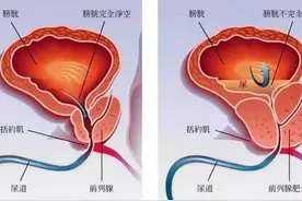 非那雄胺与盐酸坦索罗辛治疗前列腺增生哪个更好？如何选择？图片