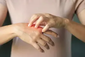 春季常起“风疙瘩”的原因大揭秘！教你一招，远离春季瘙痒~图片