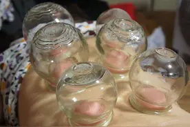 拔火罐时，后背吸出的瘀血，是身体排出的毒素吗？听听医生怎么说图片