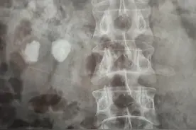 右肾两颗2.5厘米肾结石经过经皮肾镜手术顺利取出图片