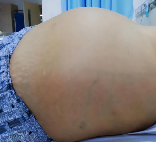 肝癌腹水怎样治疗（肝癌出现肝腹水）