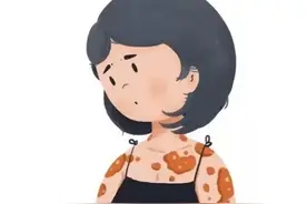 脖子后面痒抓了像癣会蔓延用什么药擦图片