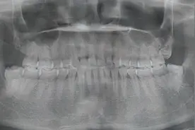 拔智齿记图片