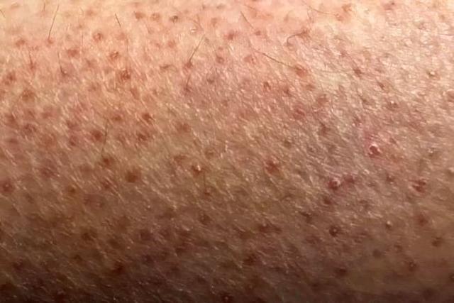 脂溢性角化病刺疼