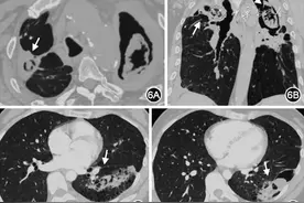 慢性阻塞性肺疾病伴肺曲霉病诊治和管理专家共识图片