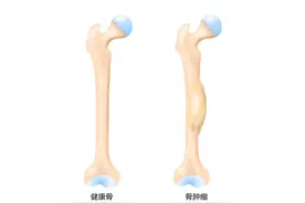 一文读懂骨癌，早期有这4点征兆图片