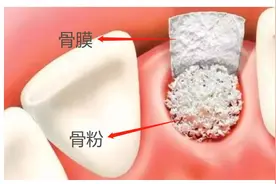 为什么种植医生在种牙前会告知需要先植骨粉？图片