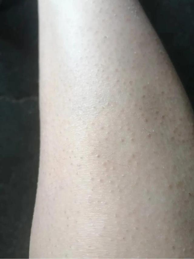 鸡皮肤用沐浴球