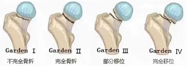 一文掌握股骨颈骨折的分型