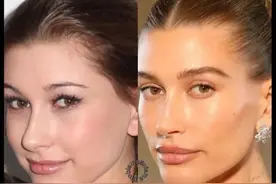 欧美整容三件套：提眉缩鼻丰唇图片