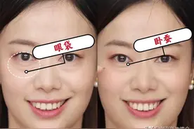 眼袋、卧蚕分不清楚？看完这篇文章你绝对能区分的明明白白图片