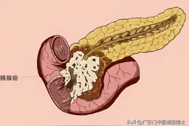 胰腺癌有哪些症状？出现这3种情况，要警惕图片