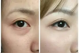 皮肤黑色素沉淀过多怎么解决？图片