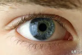 南平男子一觉醒来眼珠子歪了，到医院才发现自己患上糖尿病……图片