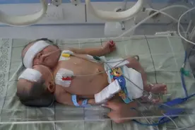 2011年，四川女子生下中国首例“双头婴儿”，之后怎么样了图片