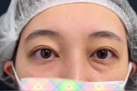忍无可忍，我还是去做了祛眼袋手术！分享一下我的感受吧图片