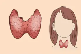 女子诊断出5cm甲状腺结节，3个月缩小了，医生：她的做法值得借鉴图片