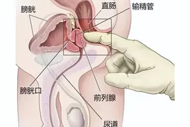 前列腺增生做了电切手术还会复发吗？图片