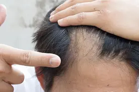 用这几个方法，让你的发际线不再后移图片