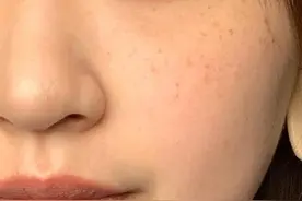 判断你脸上是“哪种斑”？雀斑很常见，晒斑好淡化，黄褐斑最好认图片