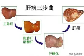酒精肝和脂肪肝有什么区别？或许看完你就明白了图片