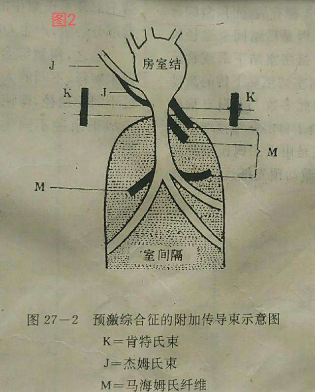 间歇性预激综合征