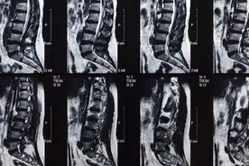腰突症患者腰痛且有灼烧感，该如何做？图片