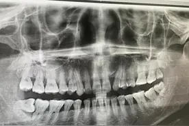 拔掉四颗智齿，意外治好了口臭图片