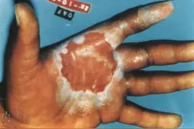 1987年，两蠢贼偷走了19克蓝色发光粉末，酿成巴西5级核灾难图片