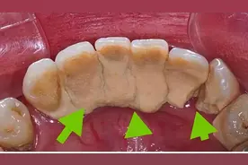 牙缝里的“小石头”又脏又臭！4招让它自动脱落！在家就能操作！图片