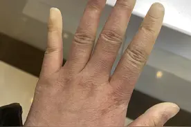 一女子在某平台嫌弃自己手丑，却被网友称有病后确诊红斑狼疮！图片