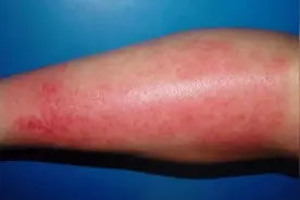 平时爱抠挖眼鼻口，竟然导致下肢染“毒”图片