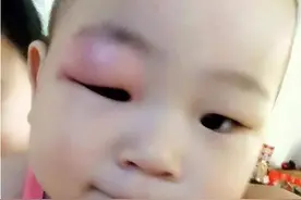 宝宝被蚊子咬后又肿又痒，咋办？宝妈亲测方法有效，完全可以效仿图片