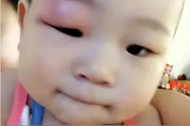 宝宝被蚊子咬后又肿又痒，咋办？宝妈亲测方法有效，完全可以效仿图片