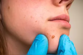 皮肤上出现的“小肉粒”是什么？医生：主要有3大类，不妨来看看图片