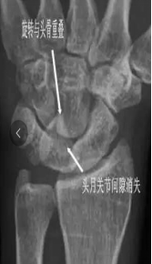 手足短骨解剖及常见疾病的影像学表现