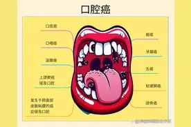 口腔癌——了解病因，可预防的肿瘤之一图片